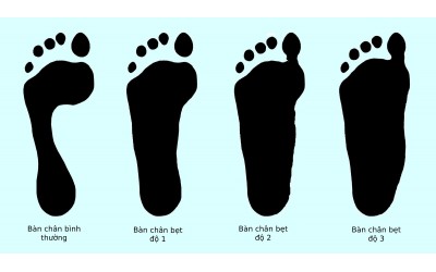 Cách chọn giày theo dáng Chân và Cơ thể