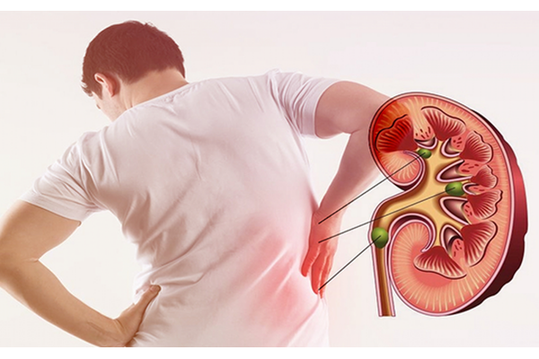 Những thói quen ăn uống dễ khiến hình thành sỏi thận