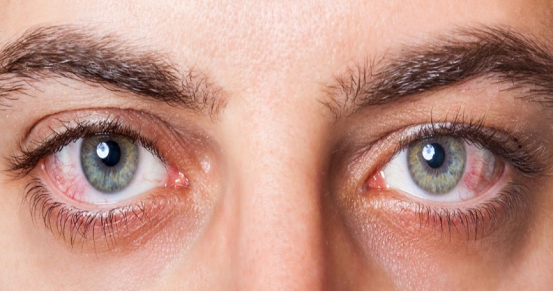Điều trị (và phòng ngừa) khô mắt vào mùa Đông Xuân